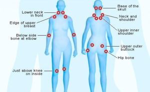 Fibromyalgia