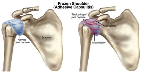 Frozen Shoulder