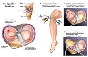 Meniscus Tear7