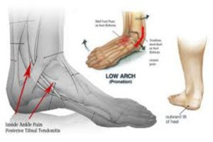 Posterior Tibialis Tendonitis