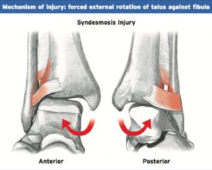 High Ankle Sprain1