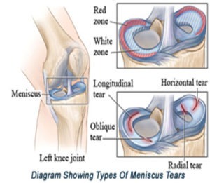 Meniscus Tear