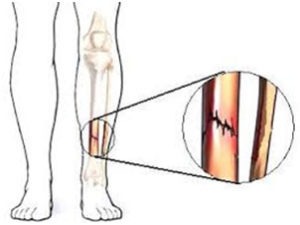 Stress Fracture