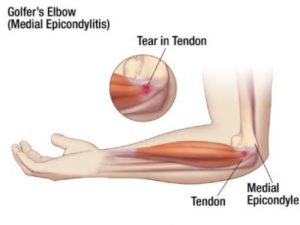 Golfers Elbow 1